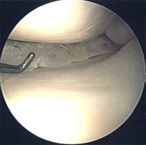 Arthroscopic Medial Meniscal Repair