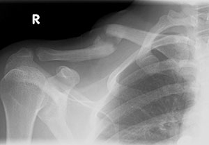 Complex Clavicle Malunion with Recurrent Fracture
