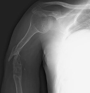International Fracture Patient with Complex Humeral Nonunion
