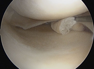Meniscal Tears