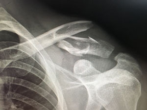 Surgical Treatment of Mountain Biking Clavicle Fracture